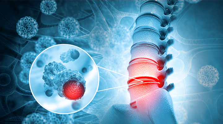 bone-metastasis-yeditepe-niversitesi-hastanesi