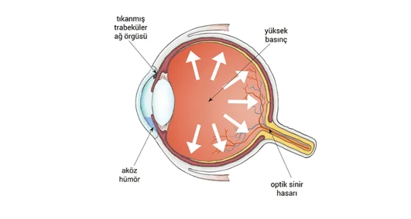 Glokom, Göz Tansiyonu Nedir?