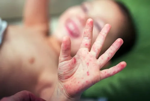 Hand Foot and Mouth Disease Symptoms and Prevention Methods