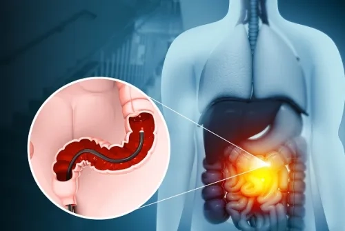Kolonoskopi Nedir? Nasıl Yapılır?