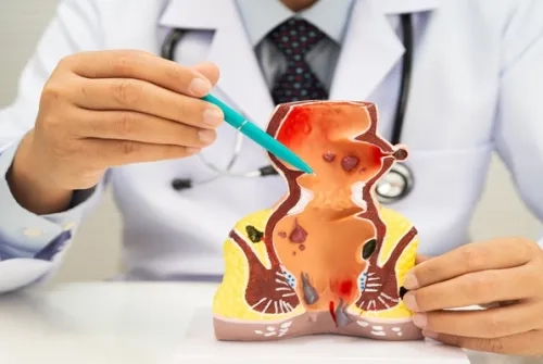 Hemoroid Nedir? Neden Olur? Nasıl Geçer? Belirtileri Nelerdir?