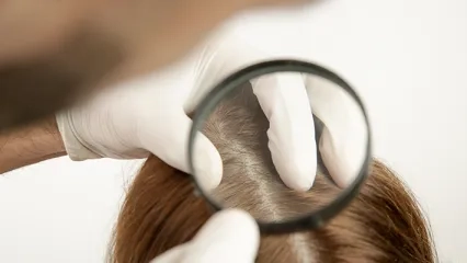 Seboreik Dermatit Halk Adıyla Konak veya Egzama