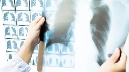 Amerikan Kanseri Derneği Açıkladı; Akciğer Kanserinde Tarama Yaşı Düştü