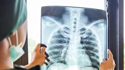 Underlying Lung Cancer Cases are Discovered with Coronavirus-related CT Scans