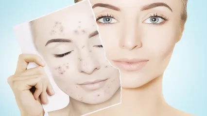 Akne ve Diyet Arasında Gerçek Bir İlişki Var mı?