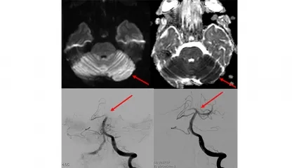 Akut İnme Tedavisinde Girişimsel Yöntemler