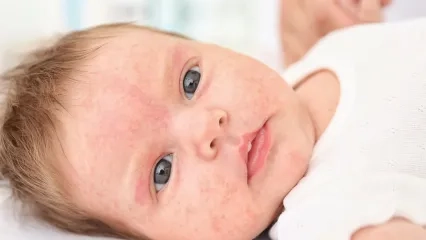 The Most Common Skin Rashes in Newborns