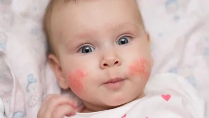 Children Whose Parents Are Allergic Are More At Risk