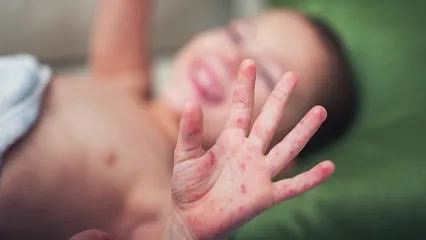 Uzmanından ‘el, ayak, ağız hastalığı’ uyarısı: “Yazın havuza giren çocuklarda daha sık görülüyor!”