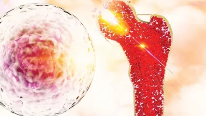 Multiple Miyelom Hastalığına Dikkat!