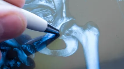 Be Careful in the First 24 Hours of Hip Fractures!