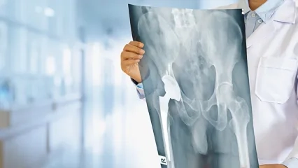 Kırık Nedir, Nasıl Tedavi Edilir?