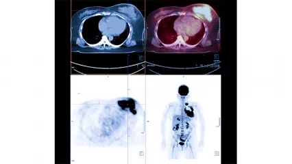 Nöroendokrin Tümörlerde Lutesyum Tedavisi