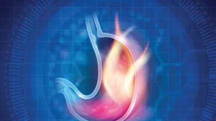 Gastroözofageal Reflü Hastalığı Nedir?