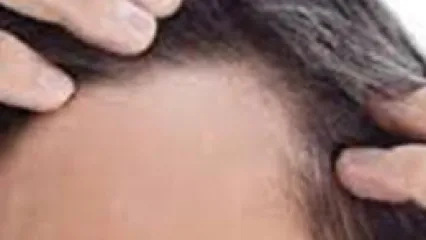 Yoğun Stres Saçkıran Yapıyor