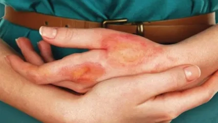 Şarbon Nasıl Bir Hastalıktır?