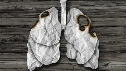 Akciğer Kanseri Tanısı Aldıktan Sonra Bile Sigarayı Bırakmak, Yaşam Süresini Etkiliyor