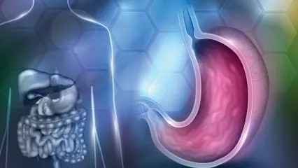 Stretta / Endoskopik Reflü Tedavisi