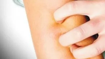 Ürtiker Yaşam Kalitesini Düşürüyor