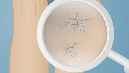 Skleroterapi Yöntemi ile Varis Tedavisi