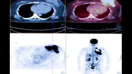 Kanser Tedavisinde Teranostik Yaklaşım