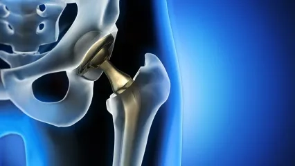 Robotik Kalça Protezi