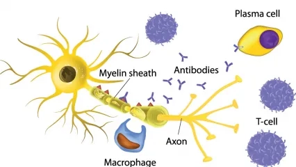 What Is Autoimmune Hypoparathyroidism or Hypocalcemia?