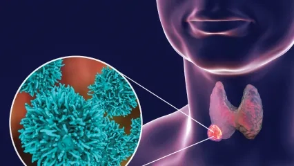 Tiroid Nodüllerinde Radyofrekans Tedavisi