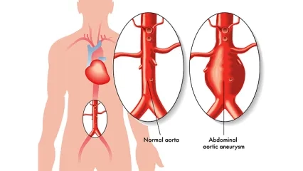 What is an Aortic Aneurysm? How is it treated?"