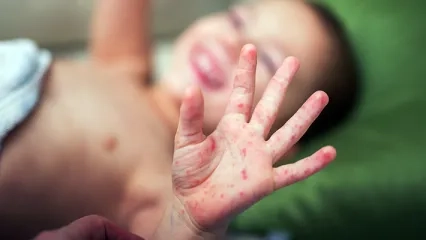Hand Foot and Mouth Disease Symptoms and Prevention Methods