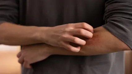 Uyuz Belirtileri