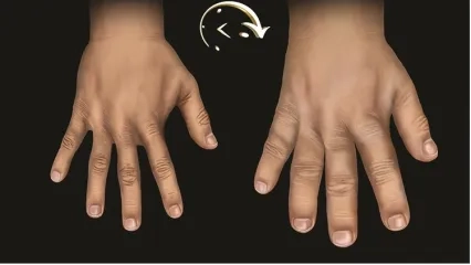 What is Acromegaly Disease?