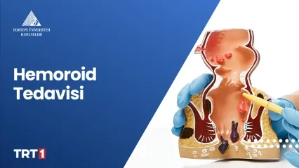 Hemoroid Tedavisi 