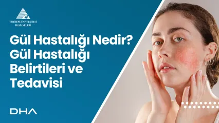 Gül Hastalığı Nedir? Gül Hastalığı Belirtileri ve Tedavisi