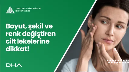 Boyut, Şekil ve Renk Değiştiren Cilt Lekelerine Dikkat