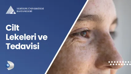 Cilt Lekeleri ve Tedavisi