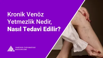 Kronik Venöz Yetmezlik Nedir, Nasıl Tedavi Edilir?