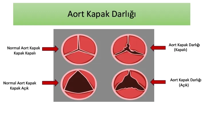 aort kapak darlığı